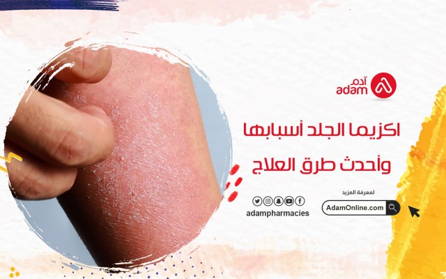 اكزيما الجلد أسبابها وأحدث طرق العلاج
