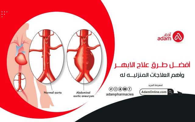 أفضل طرق علاج الابهر: وأهم العلاجات المنزلية له