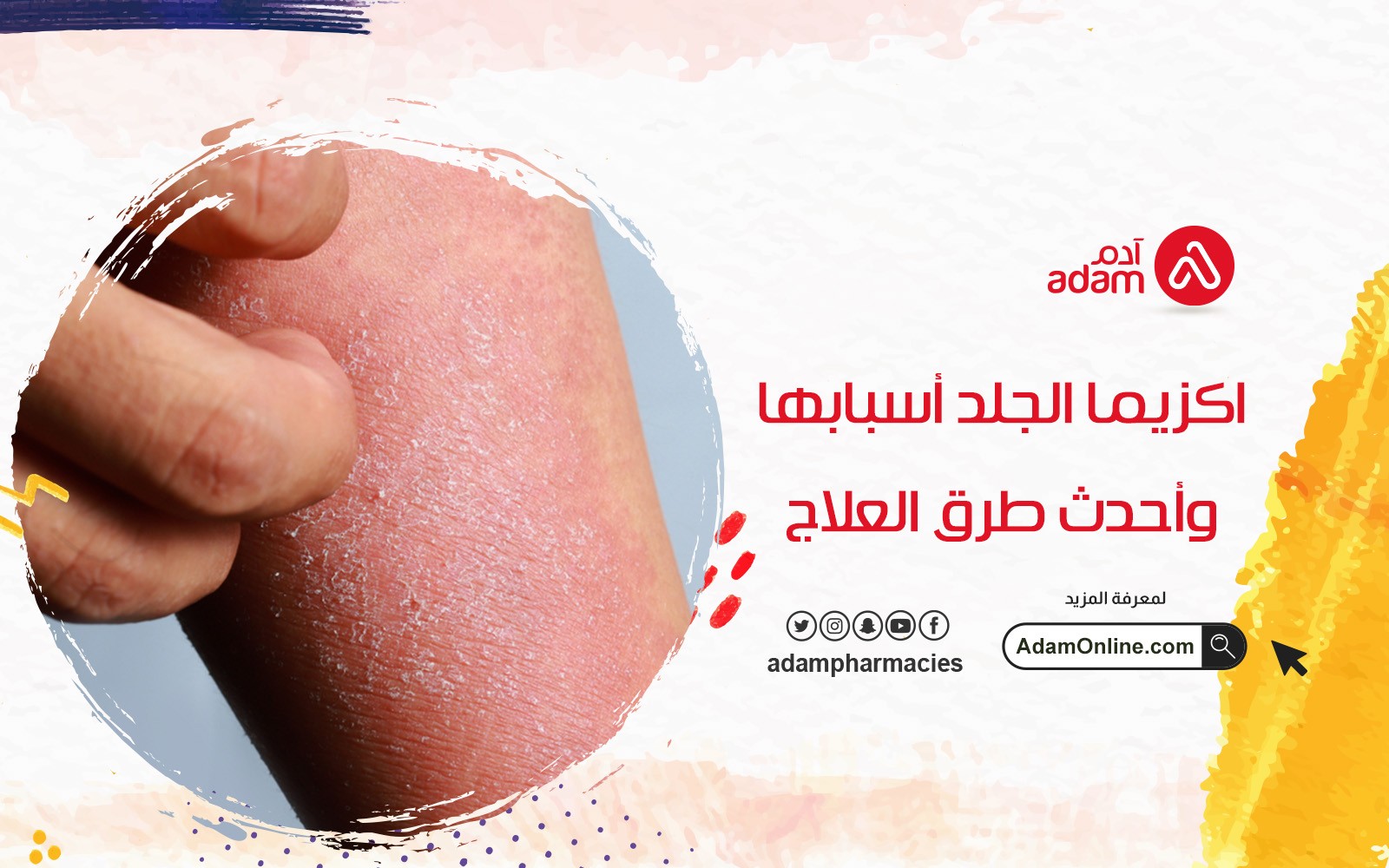اكزيما الجلد أسبابها وأحدث طرق العلاج