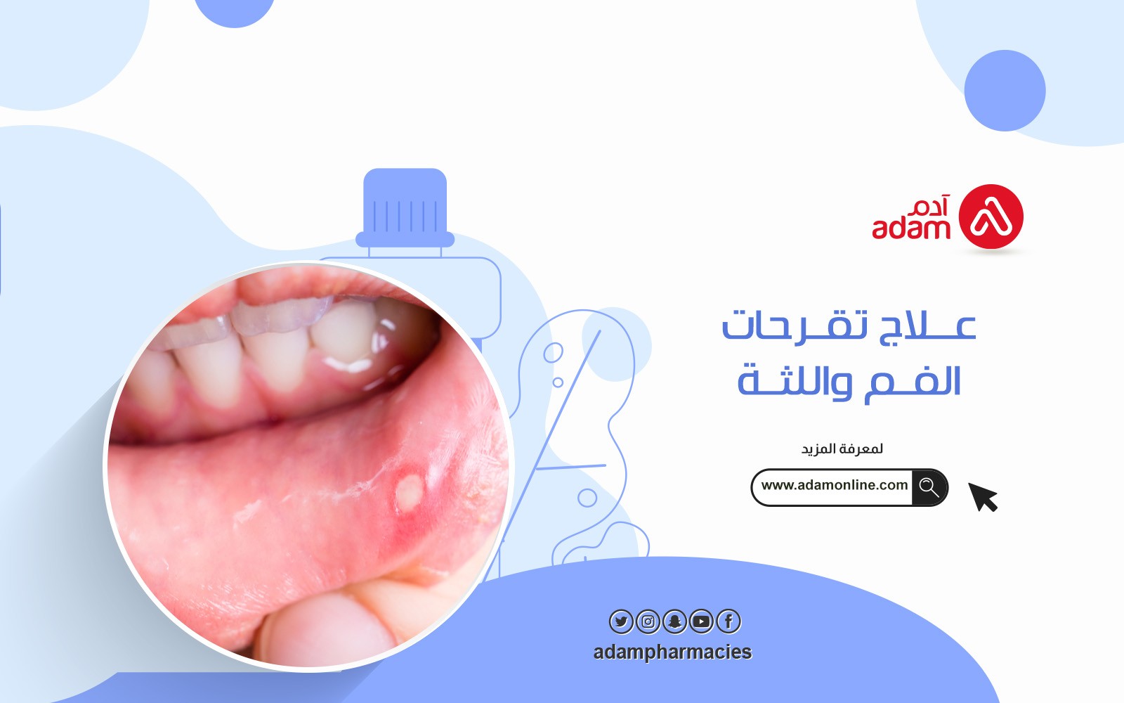 علاج تقرحات الفم واللثة